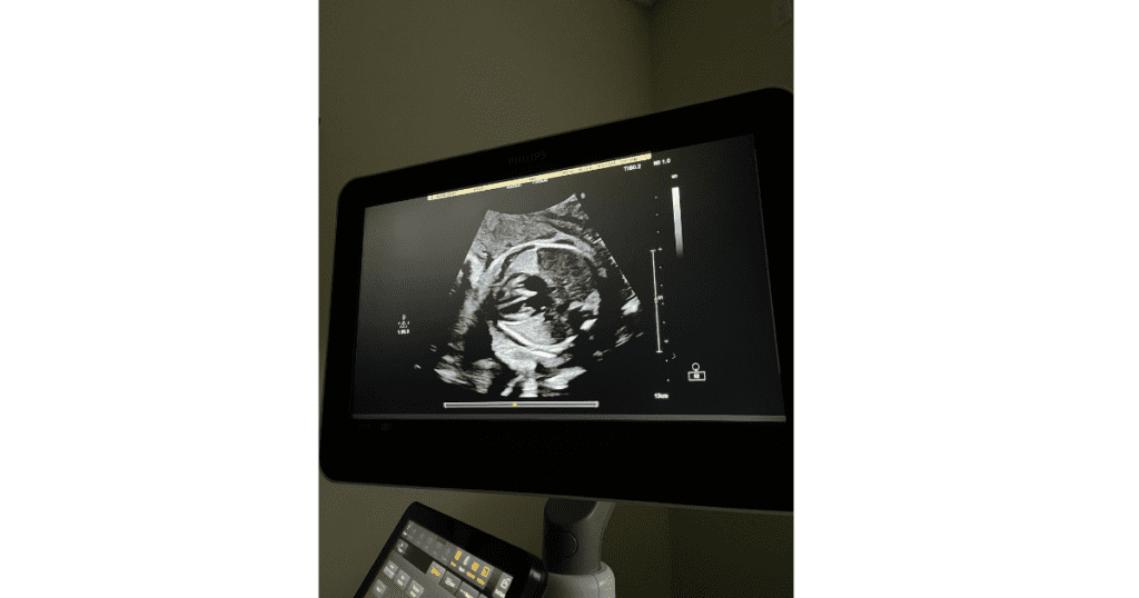 Ultrasound picture of four chambers of the heart